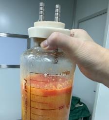 白山水动力吸脂手术要做多久？